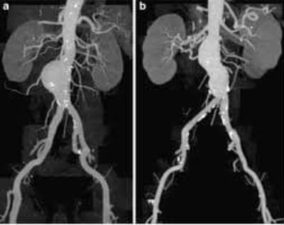 Abdominal Aortic Aneurysm: Causes, Symptoms, Treatment