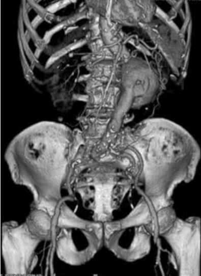 3D recon of abdominal aortic aneurysm anterior