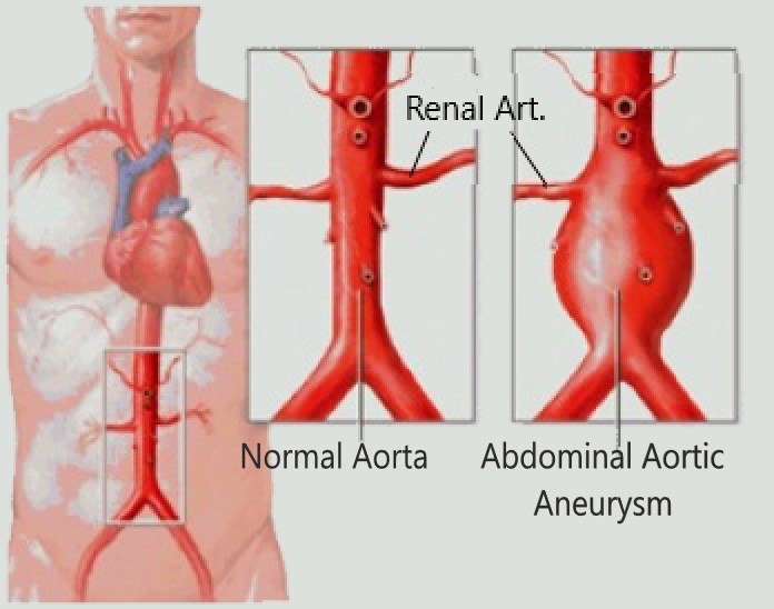Abdominal Aortic Aneurysm