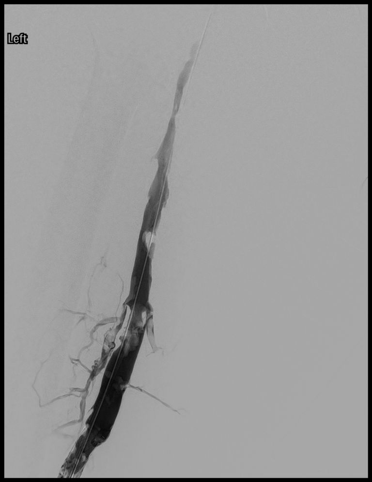 May-Thurner Syndrome