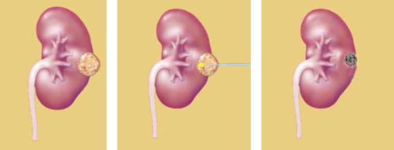 Kidney Cancer and Complex Renal Cysts