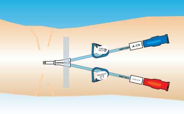 Dual lumen PICC line insertion position on the arm