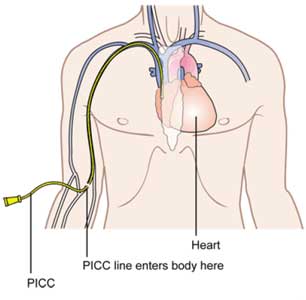 A peripherally inserted central venous catheter (PICC) enters via a brachial vein puncture on the right arm with the catheter (demonstrated in yellow) traversing the subclavian vein and terminating at the superior vena cava/right atrial junction.