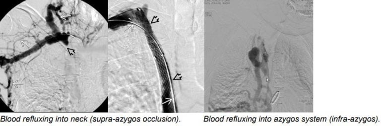 Superior Vena Cava (SVC) Syndrome