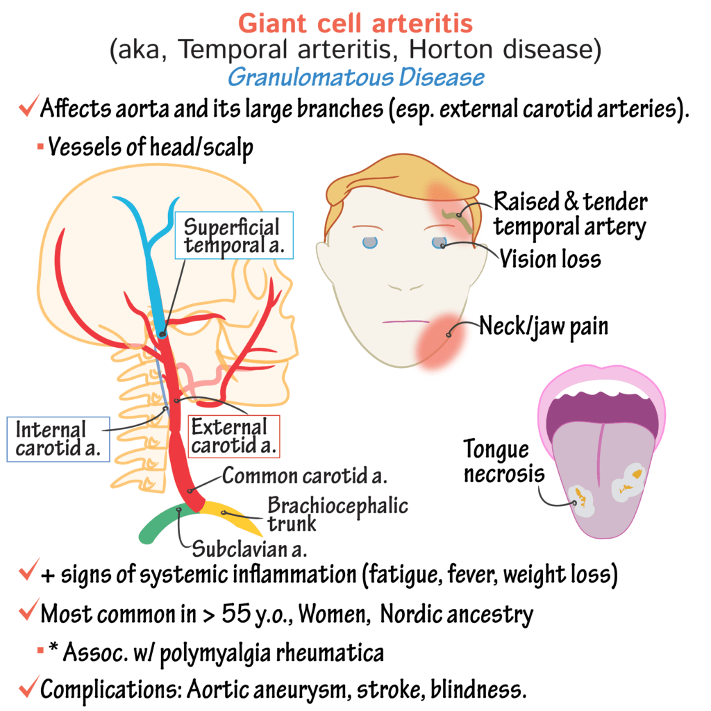 temporal arteritis