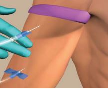 dialysis through hero graft