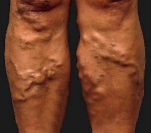lower extremity varicose veins