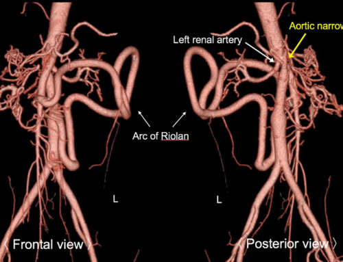 Mid-Aortic Syndrome, “Abdominal Coarctation”
