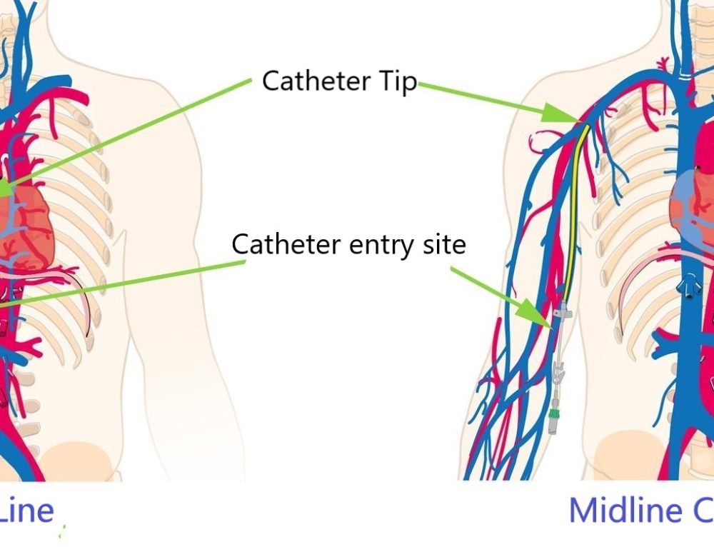 Trifusion Catheter LA Vascular