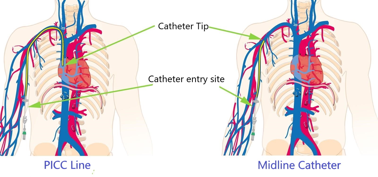 Picc line Vs Midline Catheter