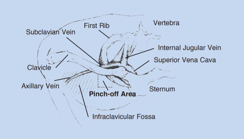 site of pinch off syndrome