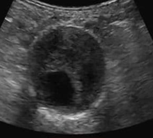 ultrasound showing a AAA with mural thrombus